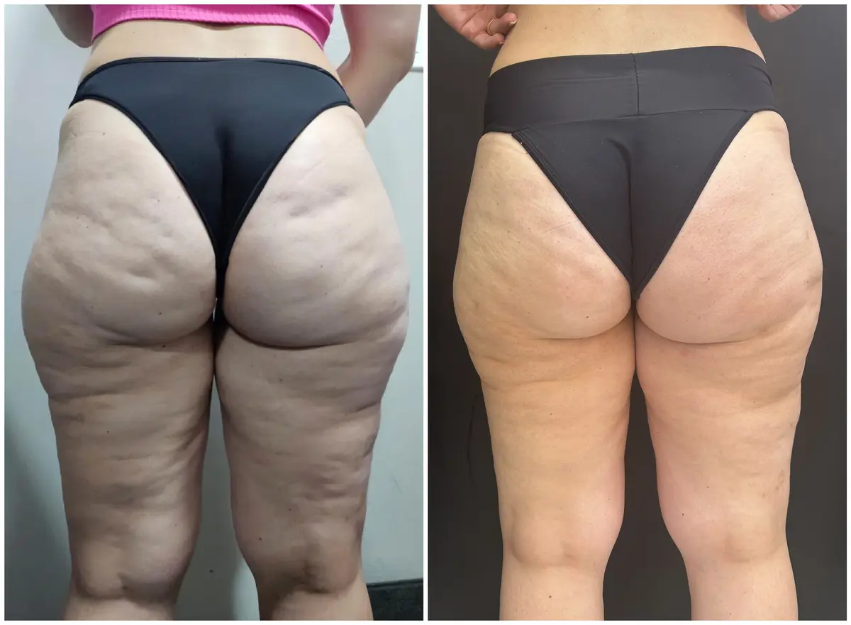 Antes e depois do tratamento de lipedema — Glúteos