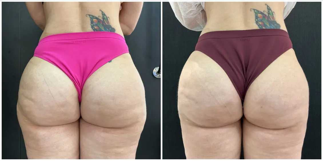 Antes e depois do tratamento de lipedema — Glúteos e coxas