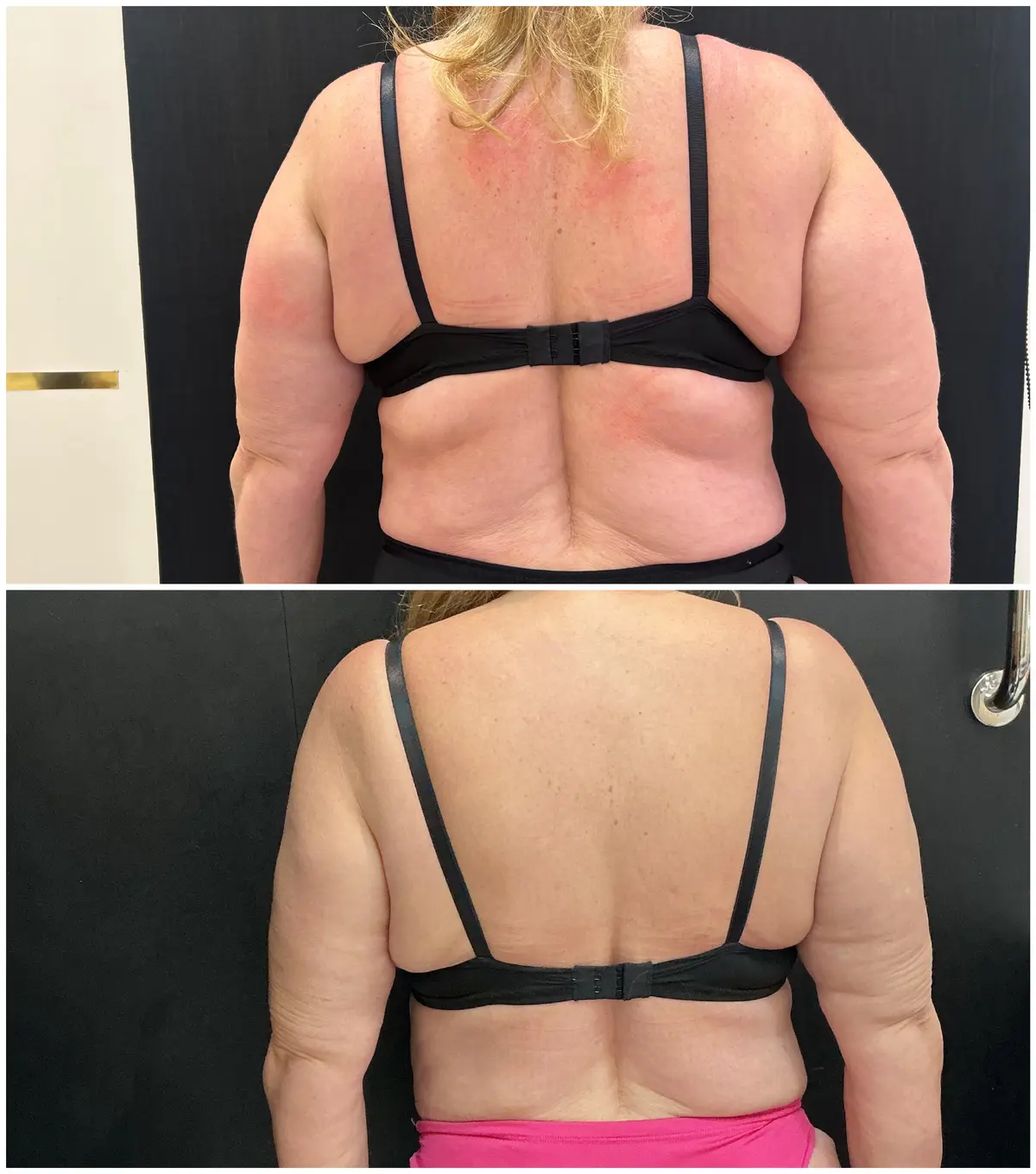 Antes e depois do tratamento de lipedema — Costas e braços