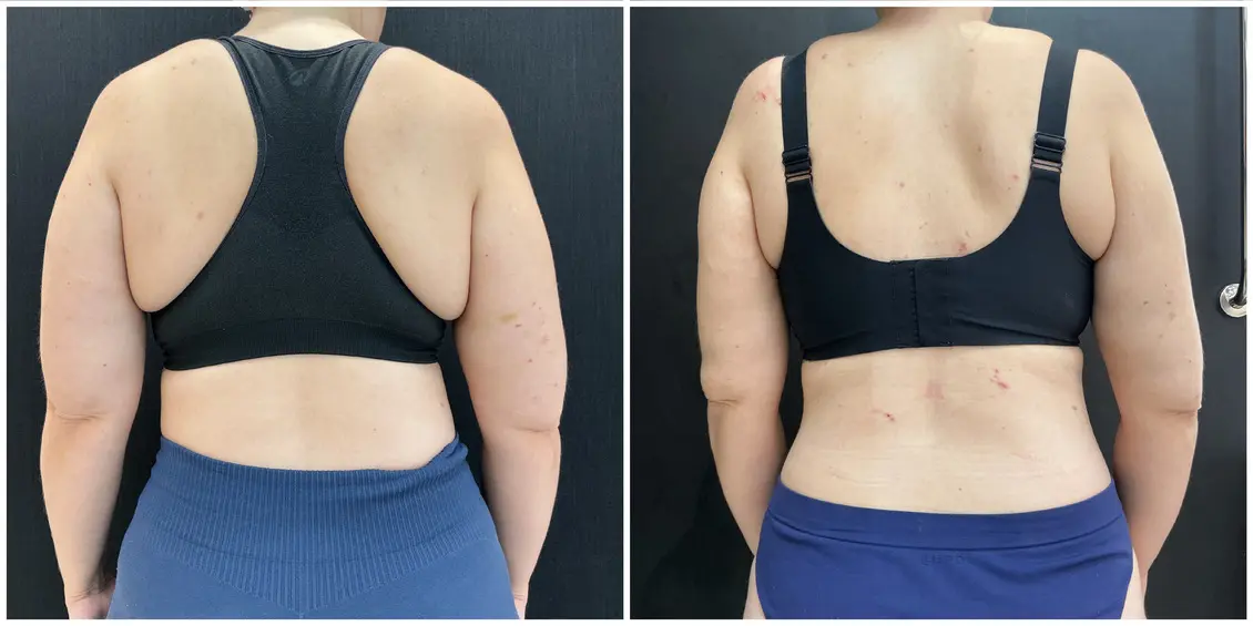 Antes e depois do tratamento de lipedema — Costas