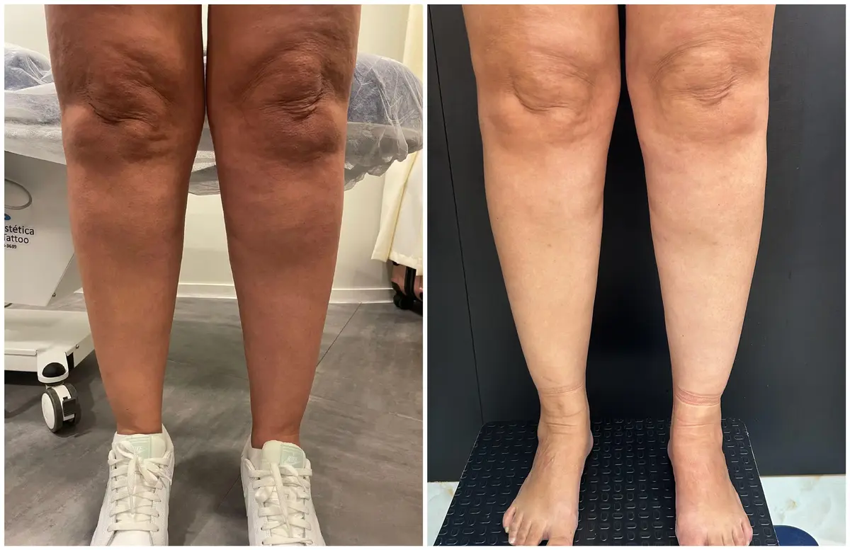 Antes e depois do tratamento de lipedema — Joelhos