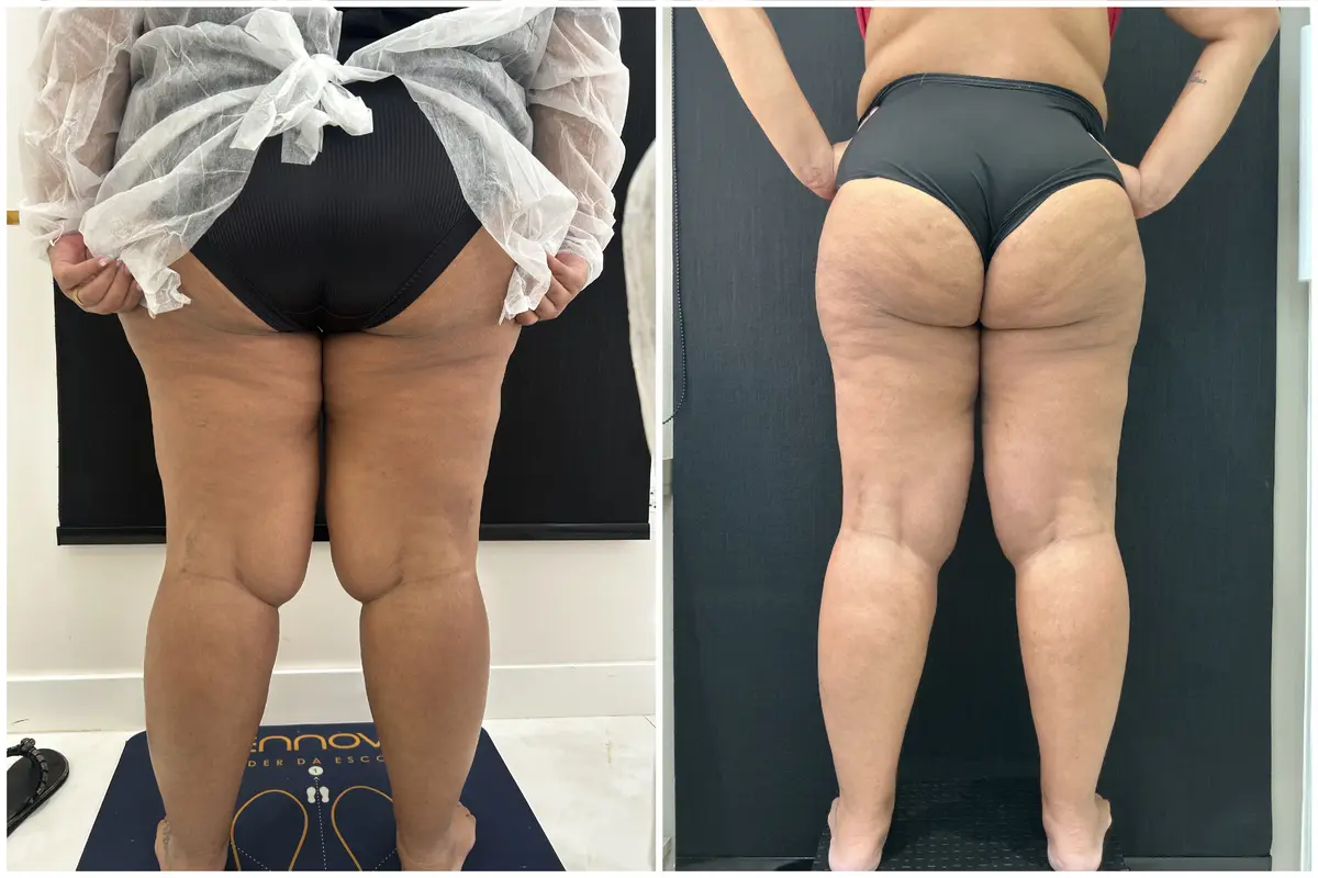 Antes e depois do tratamento de lipedema — Pernas e glúteos