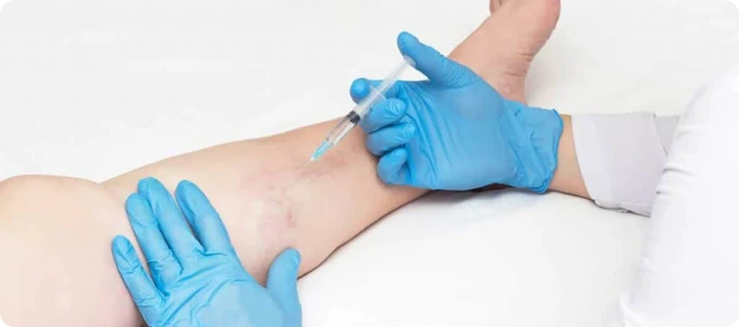 Escleroterapia com Espuma
